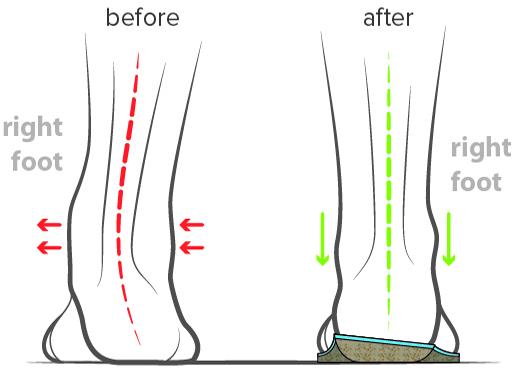 effects of insoles